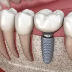Why Dental Implants Prevent Premature Facial Ageing and Sagging