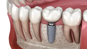 Why Dental Implants Prevent Premature Facial Ageing and Sagging