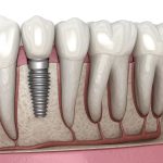 How Dental Implants Enable You to Enjoy Temperature-Sensitive Foods Without Discomfort