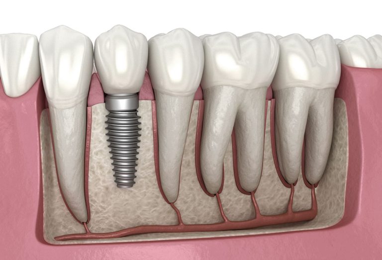 How Dental Implants Enable You to Enjoy Temperature-Sensitive Foods Without Discomfort