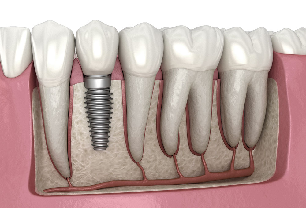 How Dental Implants Enable You to Enjoy Temperature-Sensitive Foods Without Discomfort